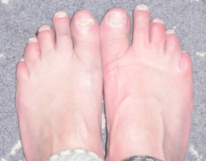toenail fungus beginning to heal