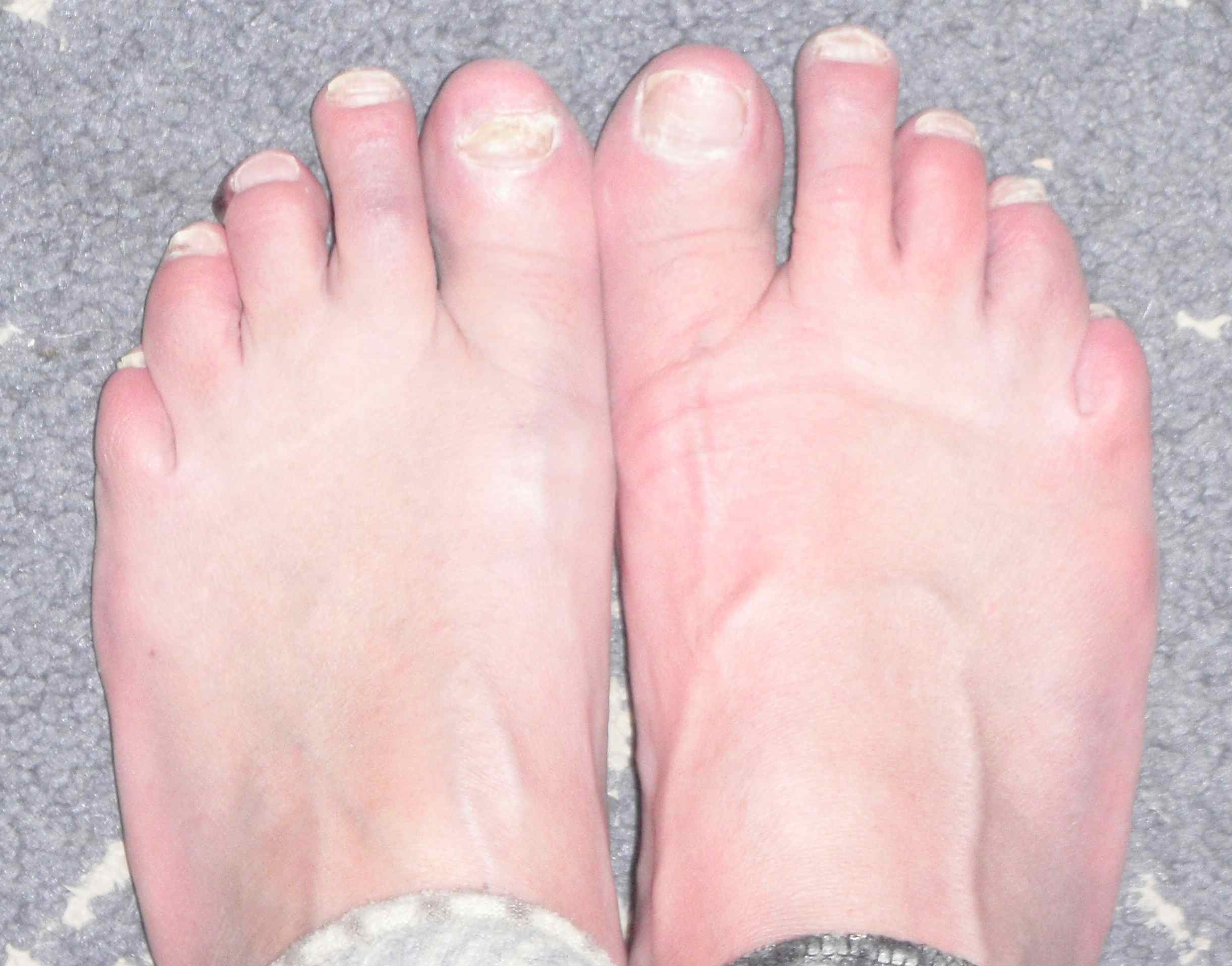 foot fungus blisters #10