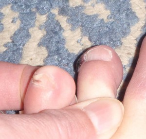 two days after the blister sprouted from the adjacent toenail
