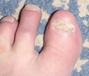 One toenail basically disintegrated when I barely bumped it on a door!