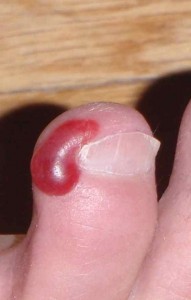 blister from wearing shoes and socks over curly toenails