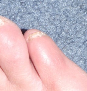the first infected pinky toe as it looks today, toe nail trimmed down so it is not quite so thick