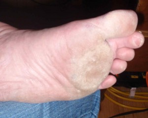 I find that my blisters heal more quickly the more I go barefoot