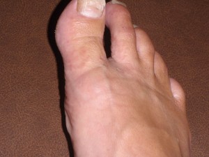itchy rash on top of toes only