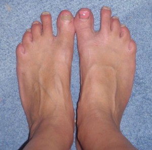 3 years ago my toes did NOT have that distinct space between the big toes and the other toes.