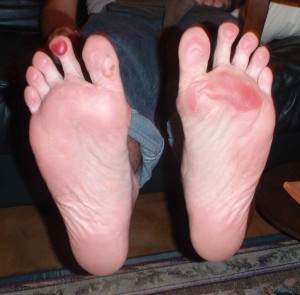 Blistered feet before the first ice bath