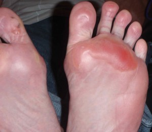 The heat induced blisters from being barefoot on hot pavement seem to keep growing.