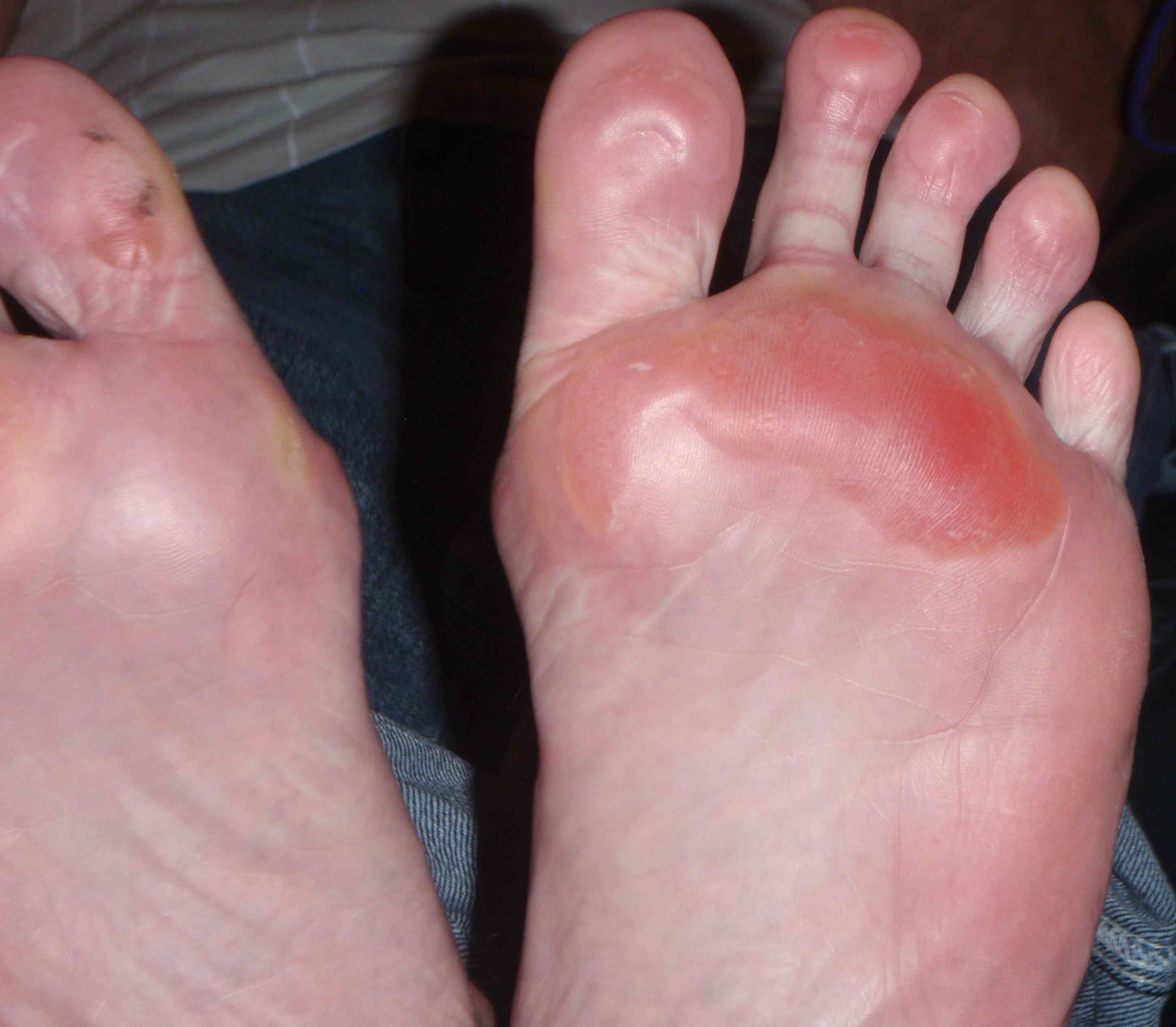 blisters on soles of feet from walking