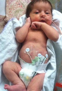 Cori Lou shows her belly 2 weeks after omphalocele surgery.